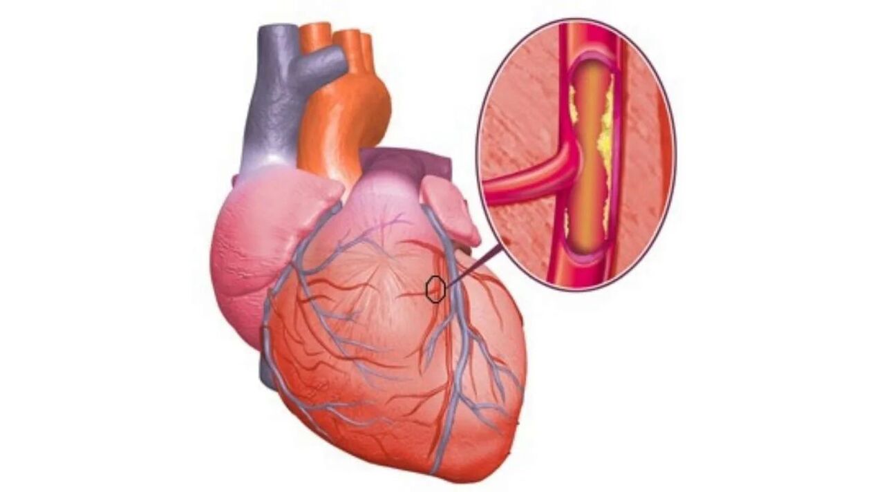 Problèmes cardiaques dus à l’hypertension artérielle. 